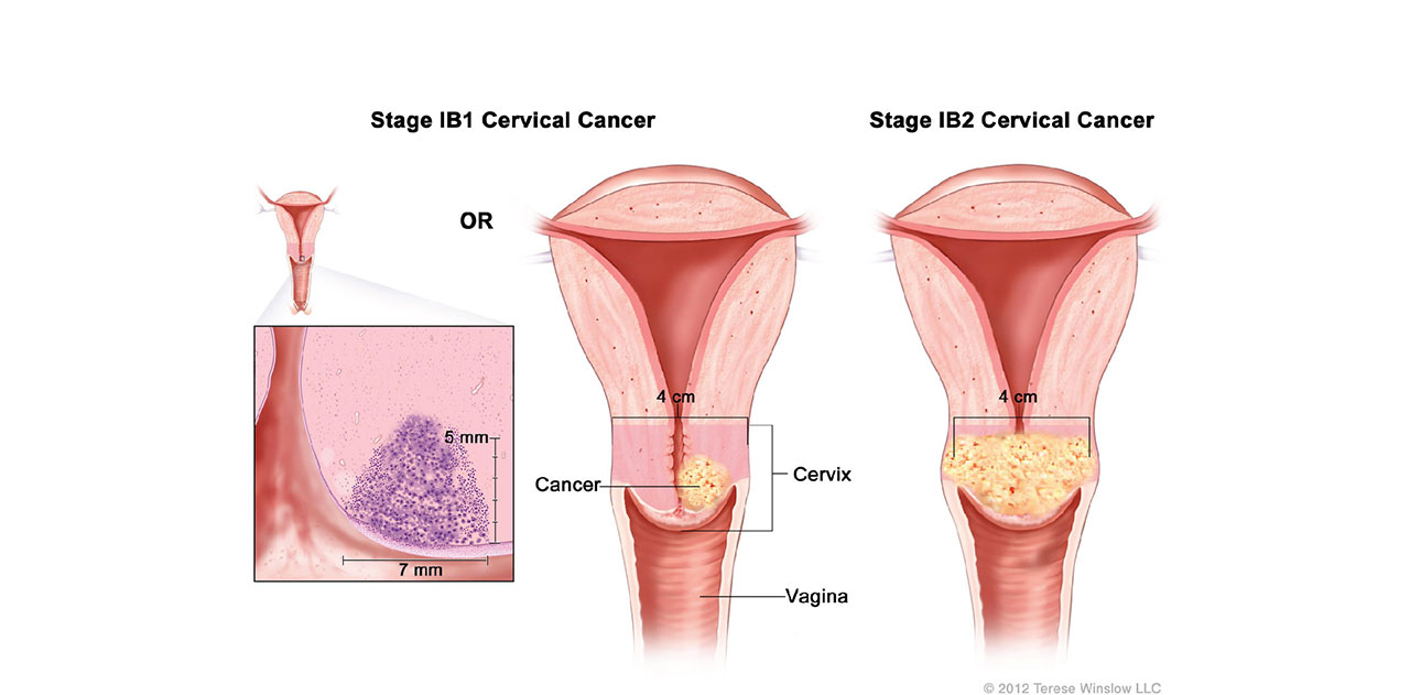 Sumber: Adi Husada Cancer Center